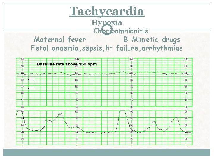 Tachycardia Hypoxia Chorioamnionitis Maternal fever B-Mimetic drugs Fetal anaemia, sepsis, ht failure, arrhythmias Tachycardia Hypoxia Chorioamnionitis Maternal fever B-Mimetic drugs Fetal anaemia, sepsis, ht failure, arrhythmias