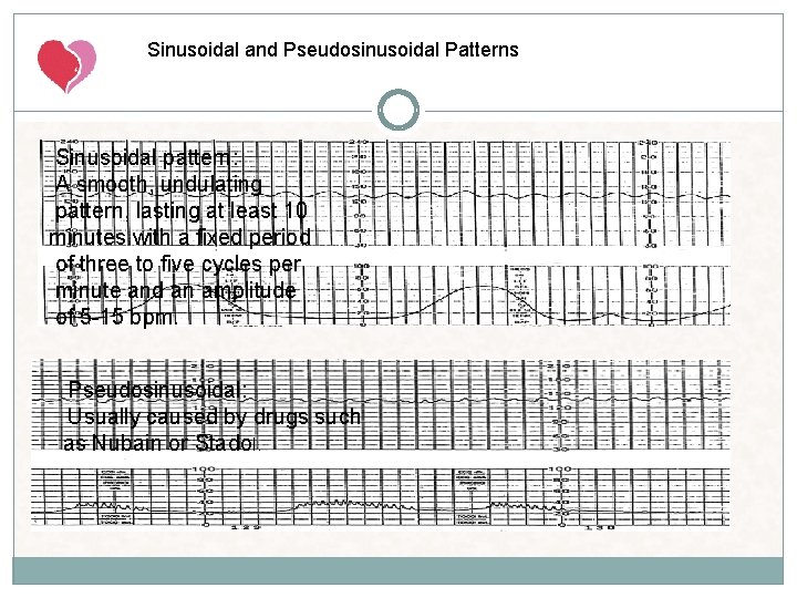 Sinusoidal and Pseudosinusoidal Patterns Sinusoidal pattern: A smooth, undulating pattern, lasting at least 10 Sinusoidal and Pseudosinusoidal Patterns Sinusoidal pattern: A smooth, undulating pattern, lasting at least 10