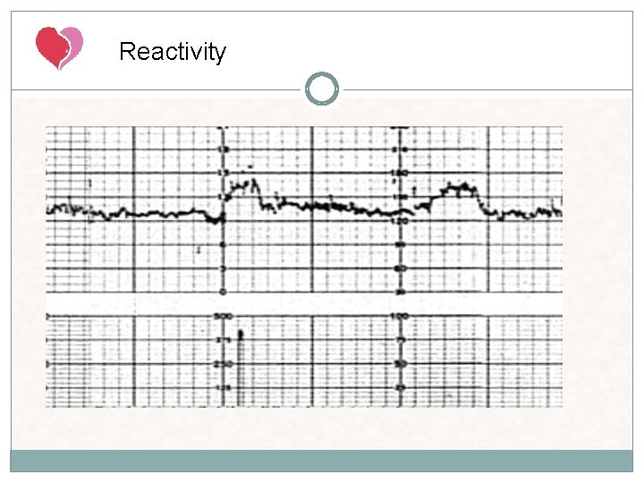 Reactivity A NST is considered reactive when two or more fetal heart rate accelerations Reactivity A NST is considered reactive when two or more fetal heart rate accelerations