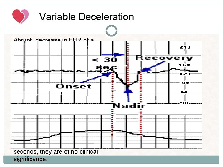 Variable Deceleration Abrupt decrease in FHR of > 15 beats per minute measured from Variable Deceleration Abrupt decrease in FHR of > 15 beats per minute measured from