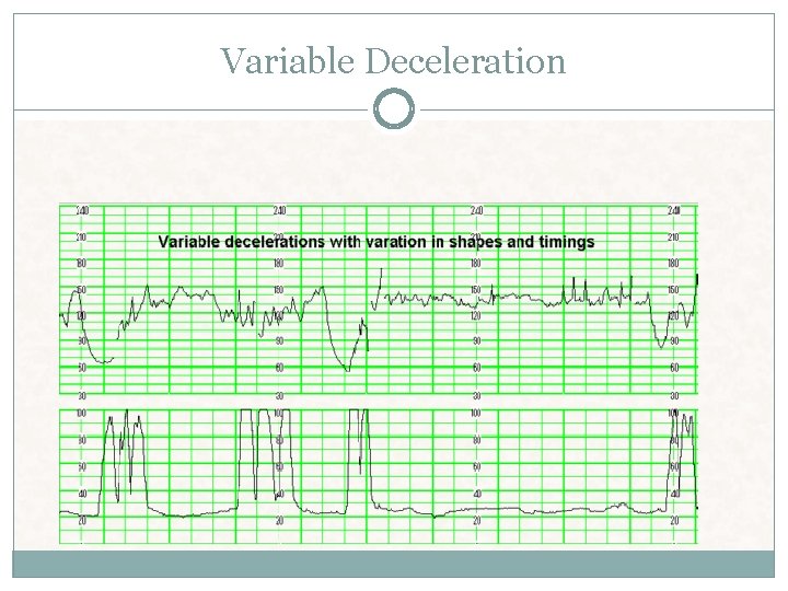 Variable Deceleration Variable Deceleration