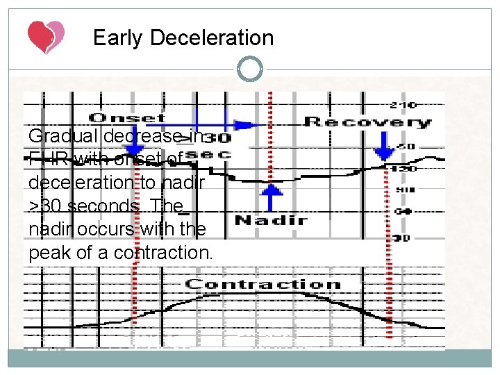Early Deceleration Gradual decrease in FHR with onset of deceleration to nadir >30 seconds. Early Deceleration Gradual decrease in FHR with onset of deceleration to nadir >30 seconds.