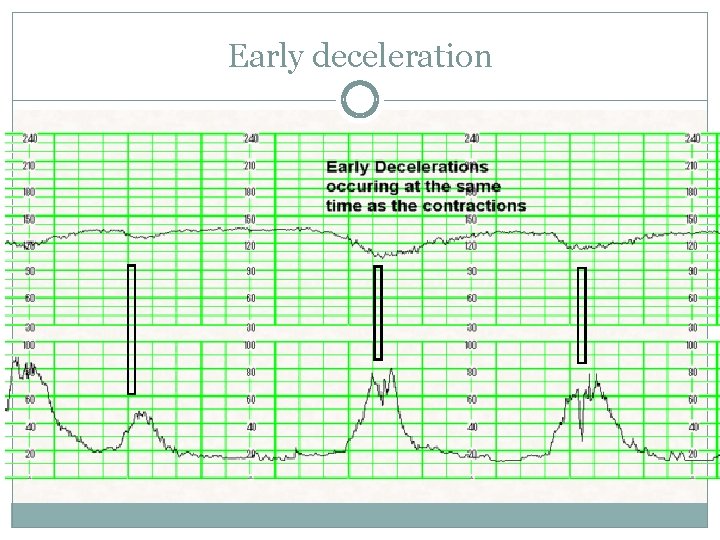 Early deceleration Early deceleration