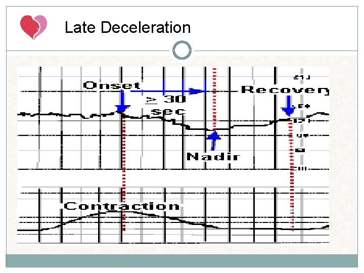 Late Deceleration Gradual decrease in FHR with onset of deceleration to nadir >30 seconds. Late Deceleration Gradual decrease in FHR with onset of deceleration to nadir >30 seconds.