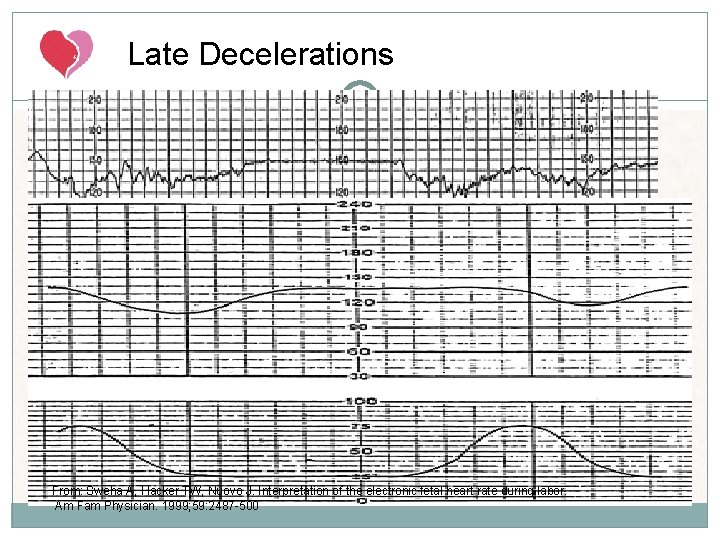 Late Decelerations From: Sweha A, Hacker TW, Nuovo J. Interpretation of the electronic fetal Late Decelerations From: Sweha A, Hacker TW, Nuovo J. Interpretation of the electronic fetal