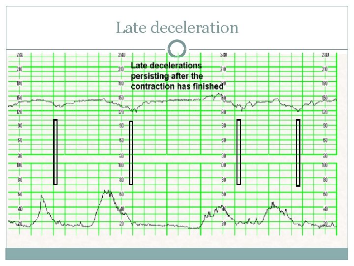Late deceleration Late deceleration
