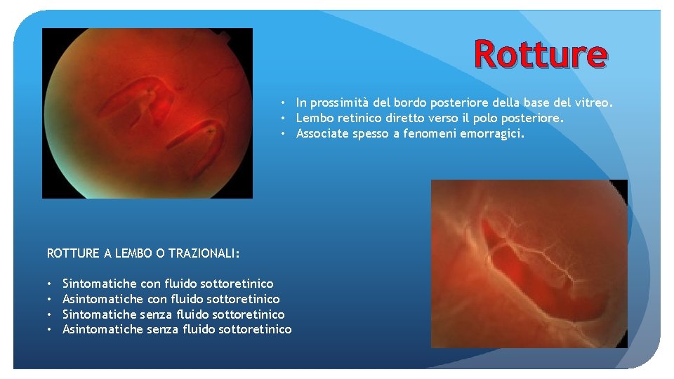 Rotture • In prossimità del bordo posteriore della base del vitreo. • Lembo retinico