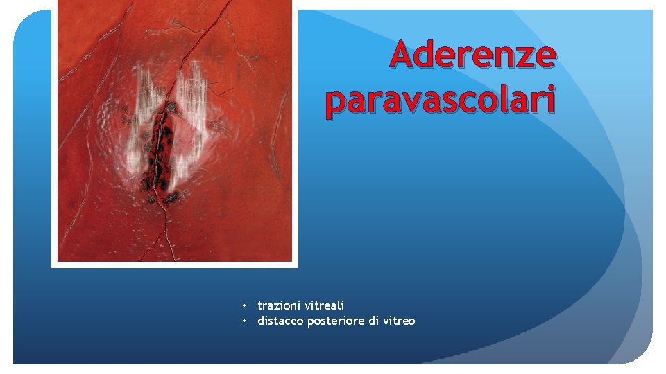 Aderenze paravascolari • trazioni vitreali • distacco posteriore di vitreo 