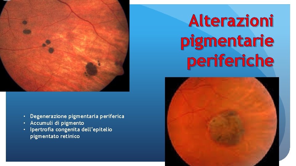 Alterazioni pigmentarie periferiche • Degenerazione pigmentaria periferica • Accumuli di pigmento • Ipertrofia congenita