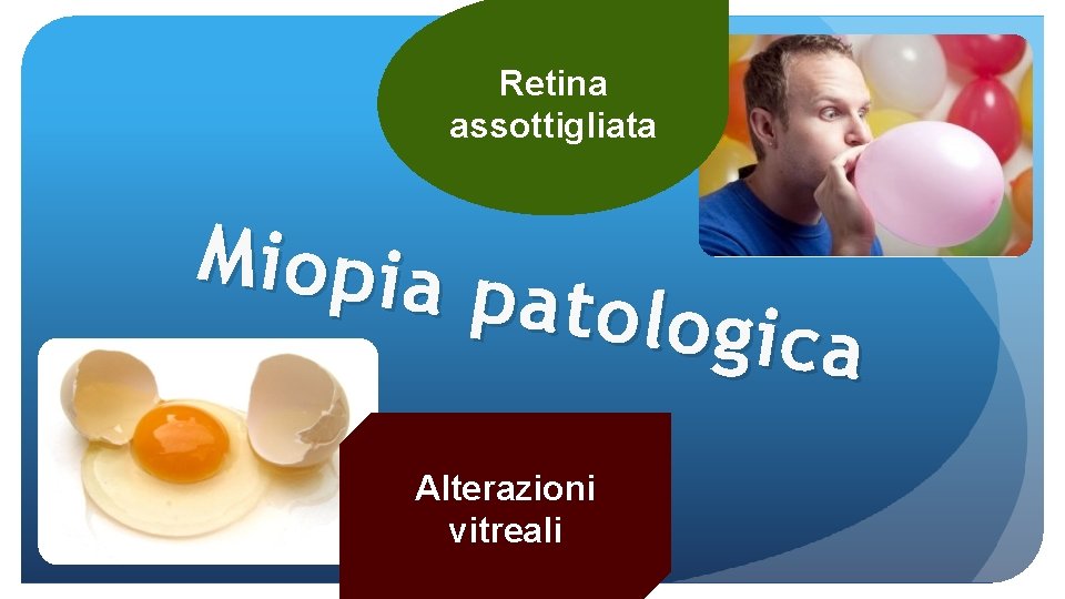 Retina assottigliata Miopia patolog ica Alterazioni vitreali 