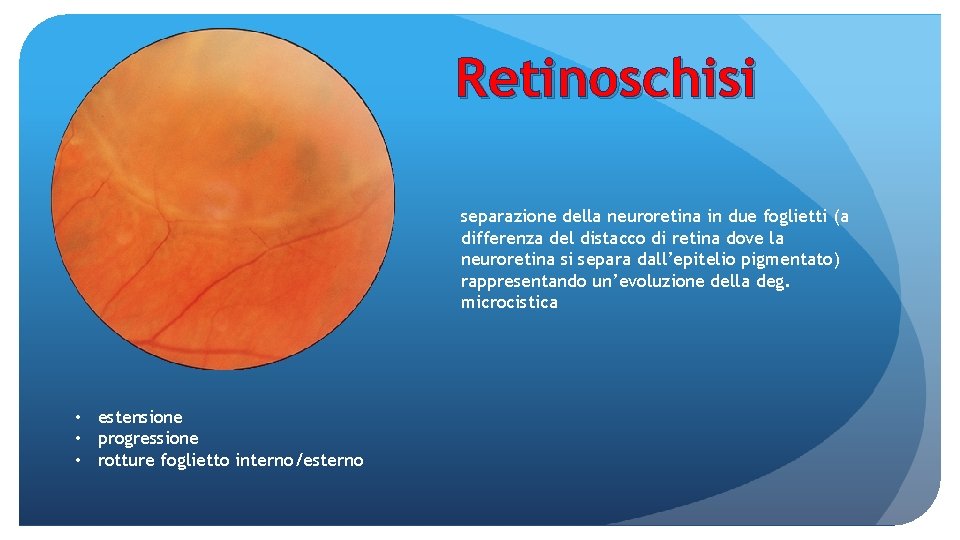 Retinoschisi separazione della neuroretina in due foglietti (a differenza del distacco di retina dove