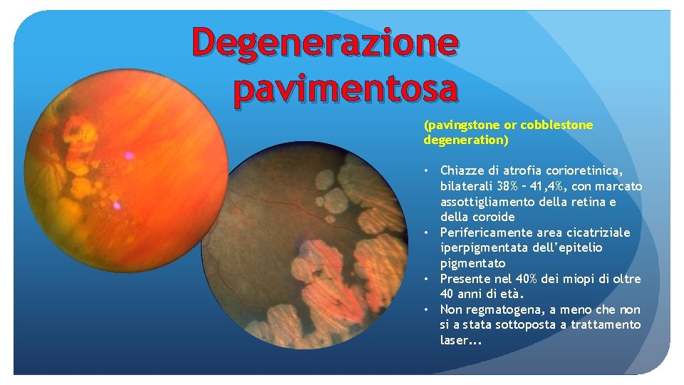 Degenerazione pavimentosa (pavingstone or cobblestone degeneration) • Chiazze di atrofia corioretinica, bilaterali 38% –