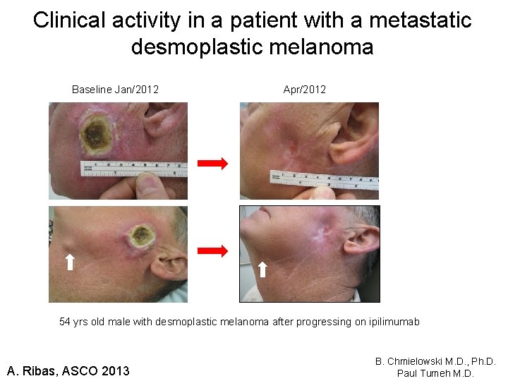 Clinical activity in a patient with a metastatic desmoplastic melanoma Baseline Jan/2012 Apr/2012 54