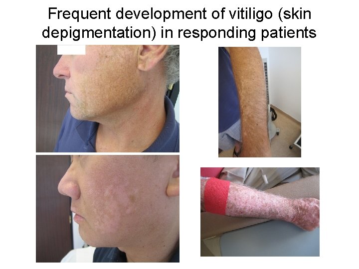 Frequent development of vitiligo (skin depigmentation) in responding patients 