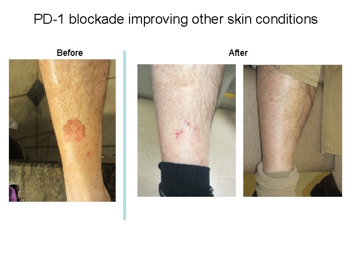 PD-1 blockade improving other skin conditions Before After 