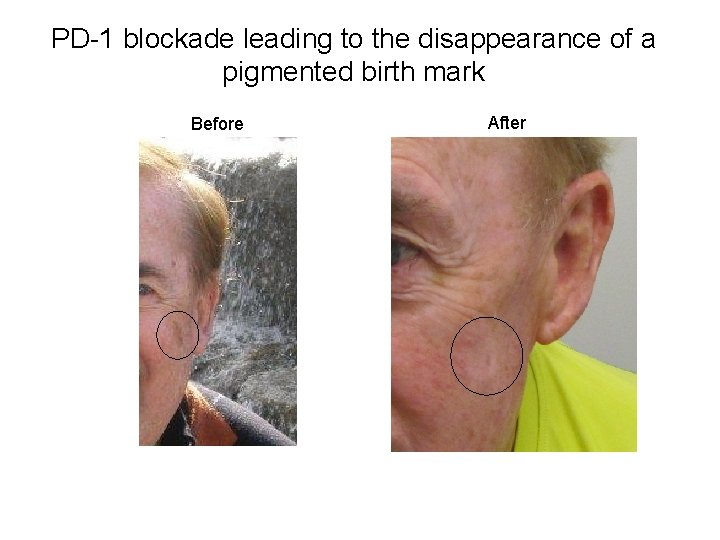 PD-1 blockade leading to the disappearance of a pigmented birth mark Before After 