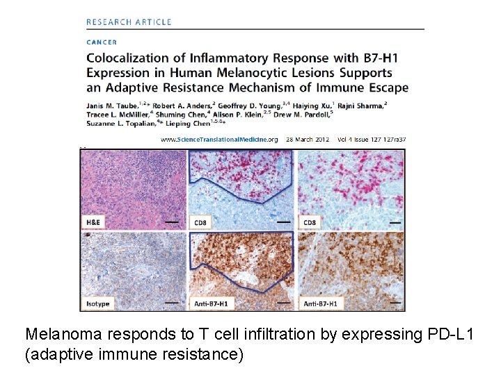 Melanoma responds to T cell infiltration by expressing PD-L 1 (adaptive immune resistance) 