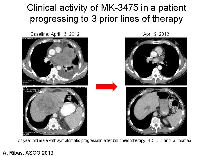 Clinical activity of MK-3475 in a patient progressing to 3 prior lines of therapy