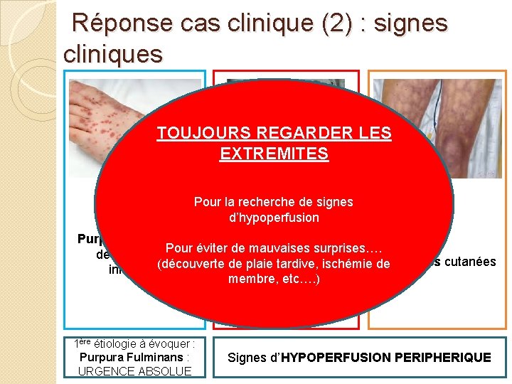  Réponse cas clinique (2) : signes cliniques TOUJOURS REGARDER LES EXTREMITES Pour la