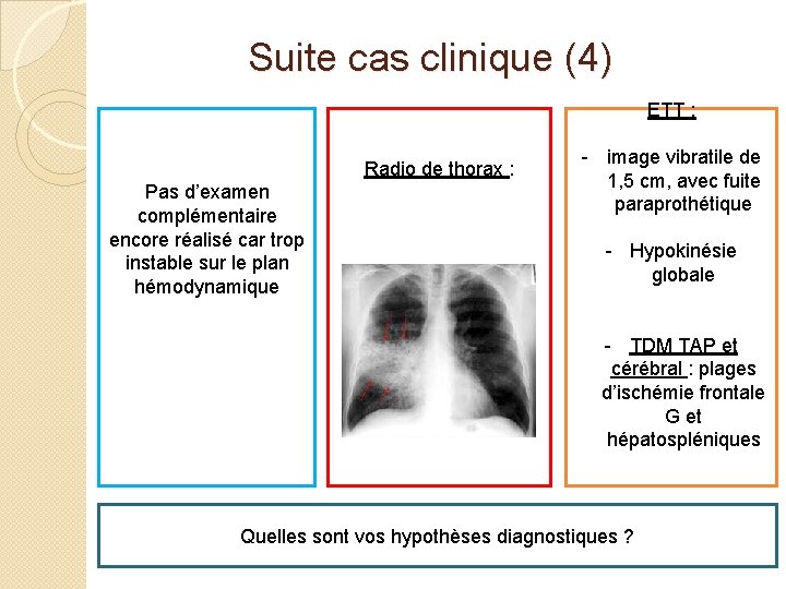 Suite cas clinique (4) ETT : Radio de thorax : Pas d’examen complémentaire encore