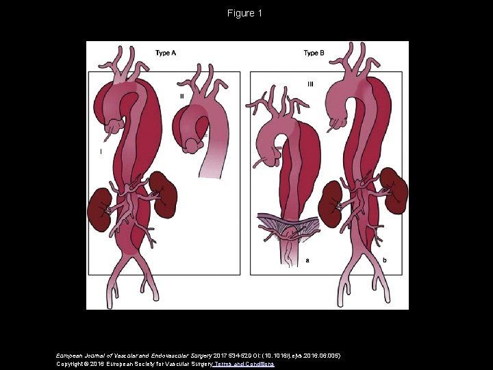 Figure 1 European Journal of Vascular and Endovascular Surgery 2017 534 -52 DOI: (10.