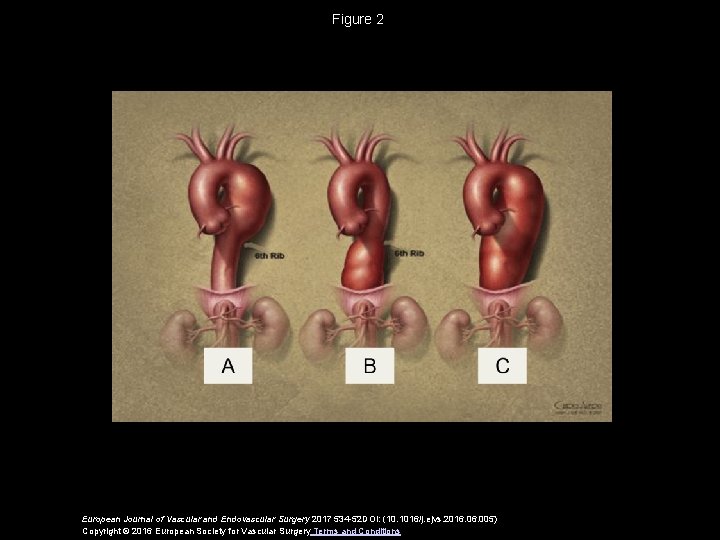 Figure 2 European Journal of Vascular and Endovascular Surgery 2017 534 -52 DOI: (10.