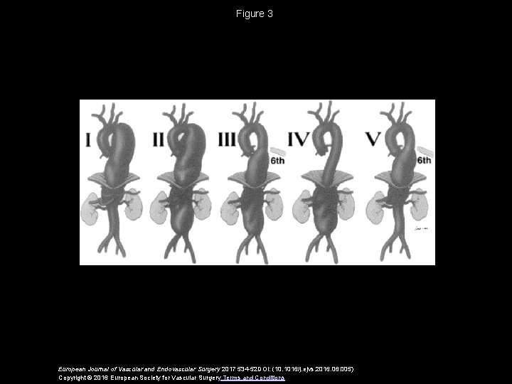 Figure 3 European Journal of Vascular and Endovascular Surgery 2017 534 -52 DOI: (10.