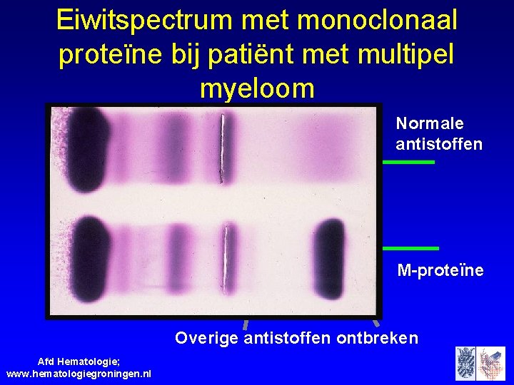 Eiwitspectrum met monoclonaal proteïne bij patiënt met multipel myeloom Normale antistoffen M-proteïne Overige antistoffen