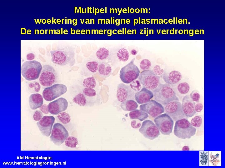 Multipel myeloom: woekering van maligne plasmacellen. De normale beenmergcellen zijn verdrongen Afd Hematologie; www.