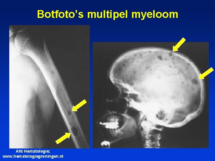 Botfoto’s multipel myeloom Afd Hematologie; www. hematologiegroningen. nl 