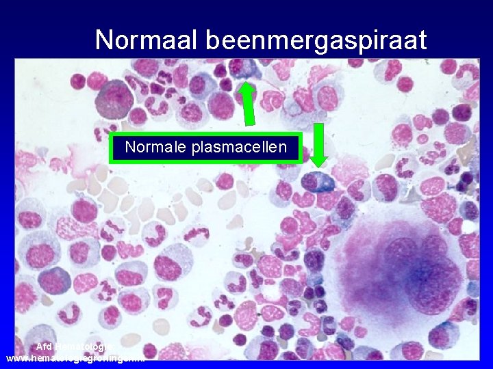 Normaal beenmergaspiraat Normale plasmacellen Afd Hematologie; www. hematologiegroningen. nl 