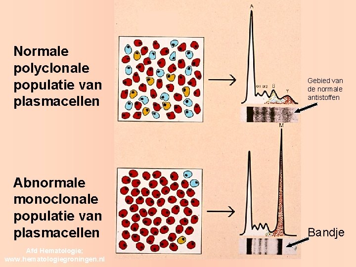 Normale polyclonale populatie van plasmacellen Abnormale monoclonale populatie van plasmacellen Afd Hematologie; www. hematologiegroningen.