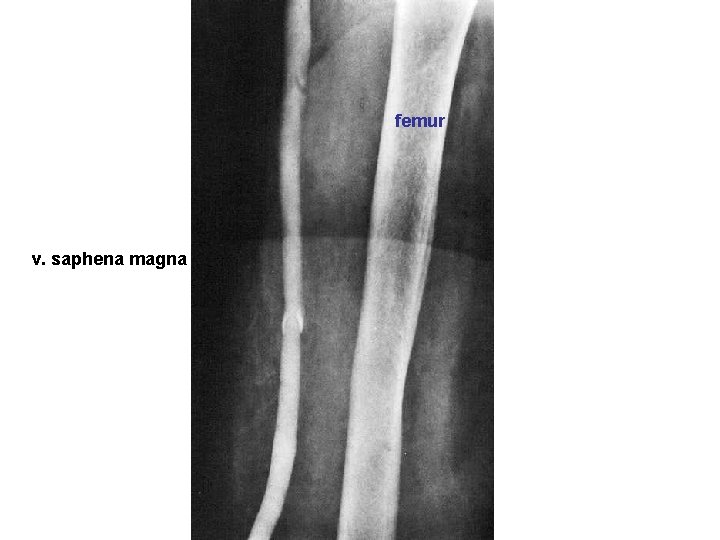 femur v. saphena magna 