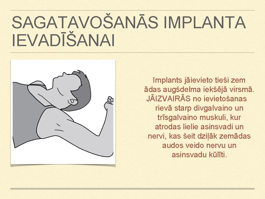SAGATAVOŠANĀS IMPLANTA IEVADĪŠANAI Implants jāievieto tieši zem ādas augšdelma iekšējā virsmā. JĀIZVAIRĀS no ievietošanas SAGATAVOŠANĀS IMPLANTA IEVADĪŠANAI Implants jāievieto tieši zem ādas augšdelma iekšējā virsmā. JĀIZVAIRĀS no ievietošanas