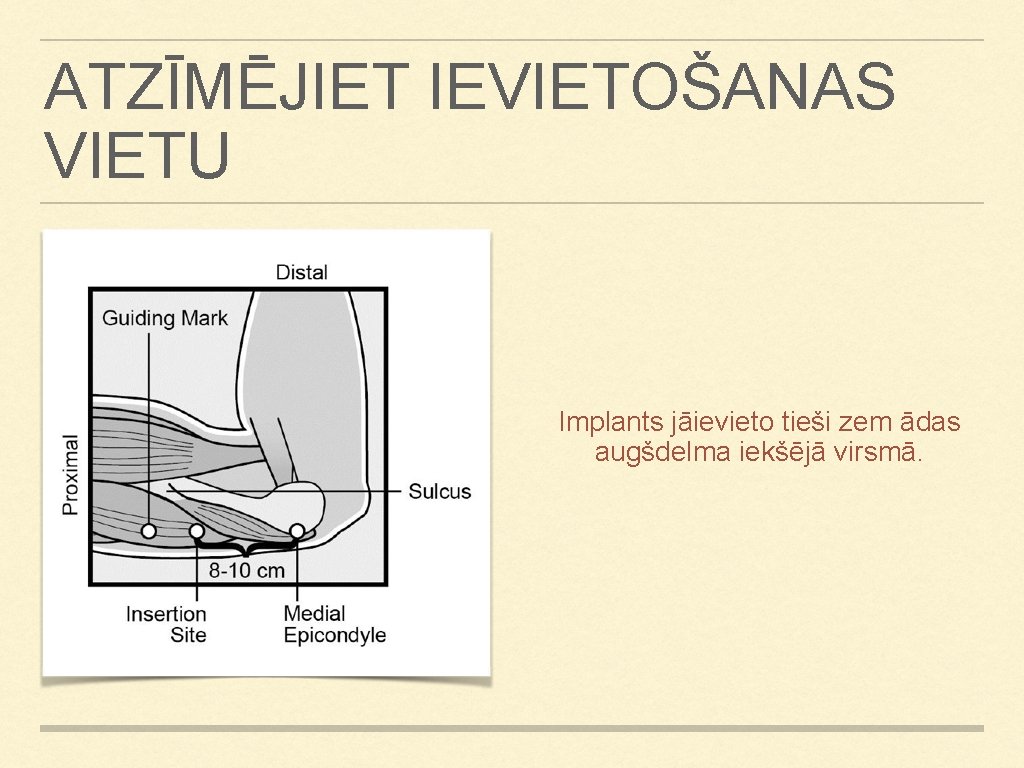 ATZĪMĒJIET IEVIETOŠANAS VIETU Implants jāievieto tieši zem ādas augšdelma iekšējā virsmā. ATZĪMĒJIET IEVIETOŠANAS VIETU Implants jāievieto tieši zem ādas augšdelma iekšējā virsmā.
