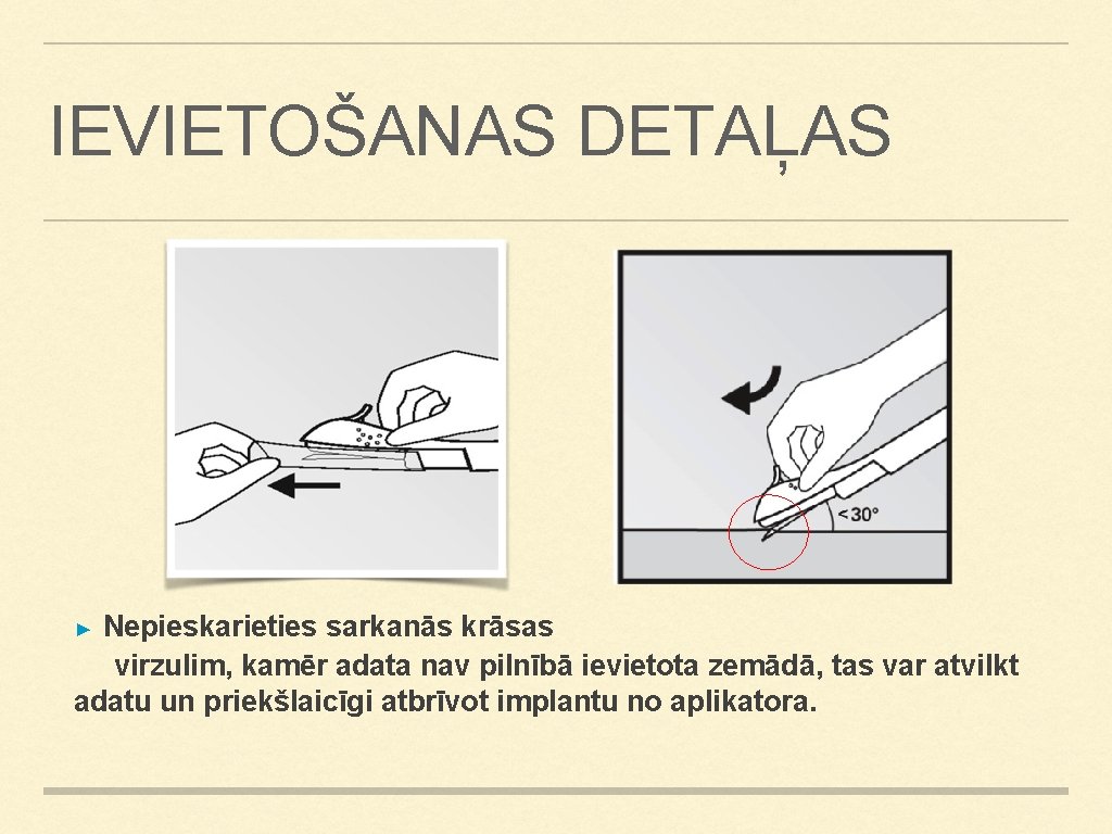 IEVIETOŠANAS DETAĻAS Nepieskarieties sarkanās krāsas virzulim, kamēr adata nav pilnībā ievietota zemādā, tas var IEVIETOŠANAS DETAĻAS Nepieskarieties sarkanās krāsas virzulim, kamēr adata nav pilnībā ievietota zemādā, tas var