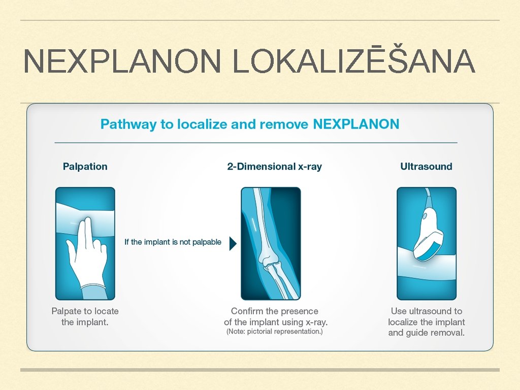 NEXPLANON LOKALIZĒŠANA NEXPLANON LOKALIZĒŠANA