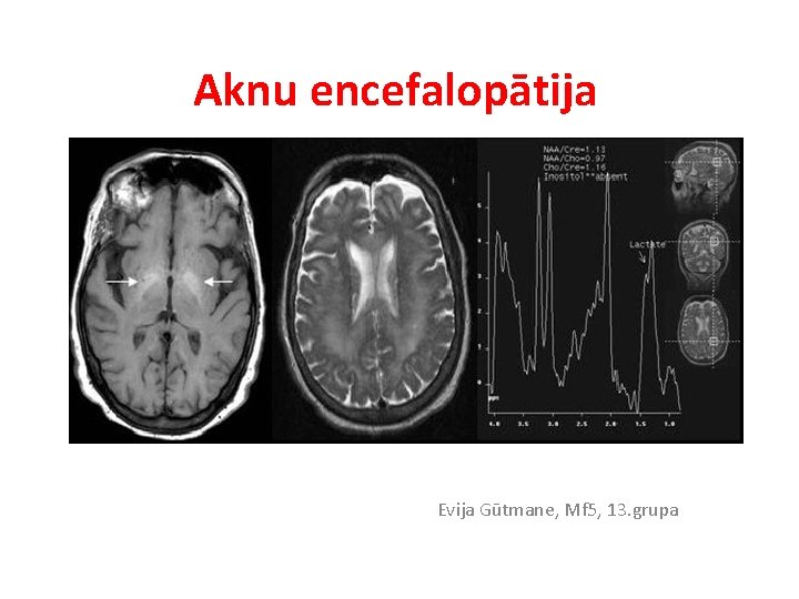 Aknu encefalopātija Evija Gūtmane, Mf 5, 13. grupa 