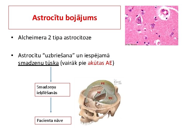 Astrocītu bojājums • Alcheimera 2 tipa astrocitoze • Astrocītu “uzbriešana” un iespējamā smadzeņu tūska