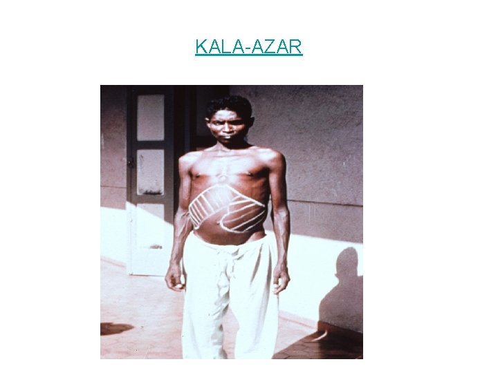 KALA-AZAR 