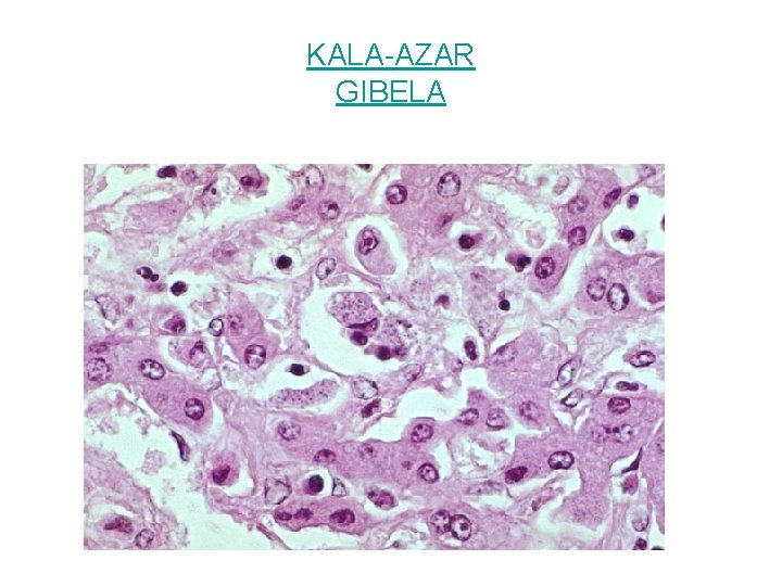 KALA-AZAR GIBELA 