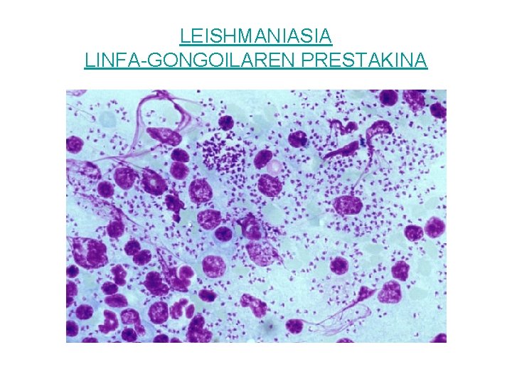 LEISHMANIASIA LINFA-GONGOILAREN PRESTAKINA 