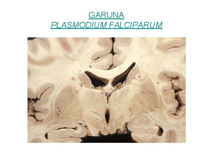 GARUNA PLASMODIUM FALCIPARUM 