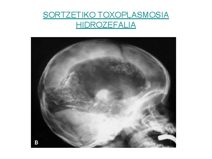 SORTZETIKO TOXOPLASMOSIA HIDROZEFALIA 