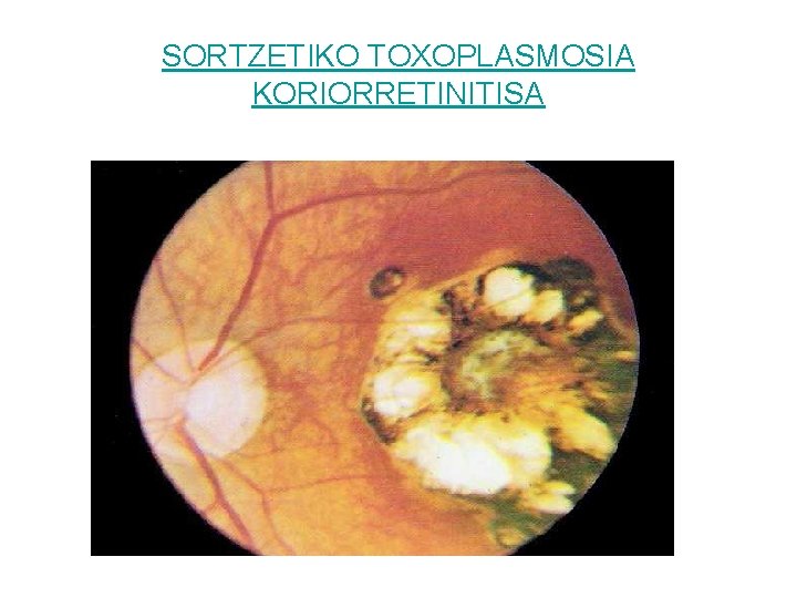 SORTZETIKO TOXOPLASMOSIA KORIORRETINITISA 