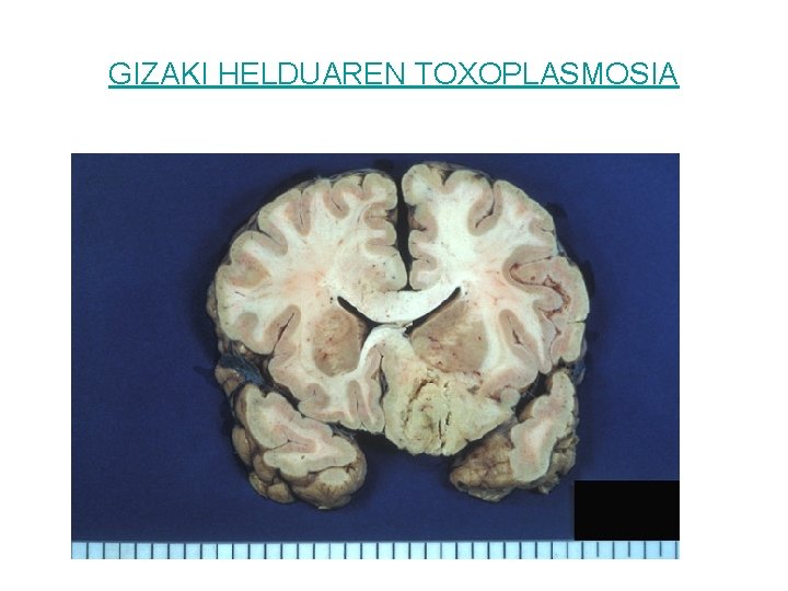 GIZAKI HELDUAREN TOXOPLASMOSIA 