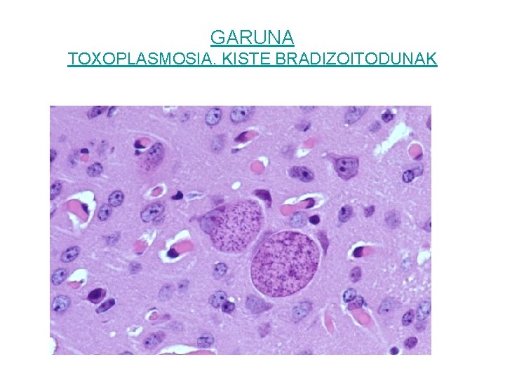 GARUNA TOXOPLASMOSIA. KISTE BRADIZOITODUNAK 