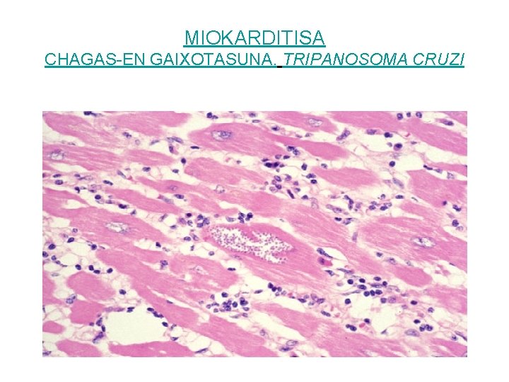 MIOKARDITISA CHAGAS-EN GAIXOTASUNA. TRIPANOSOMA CRUZI 