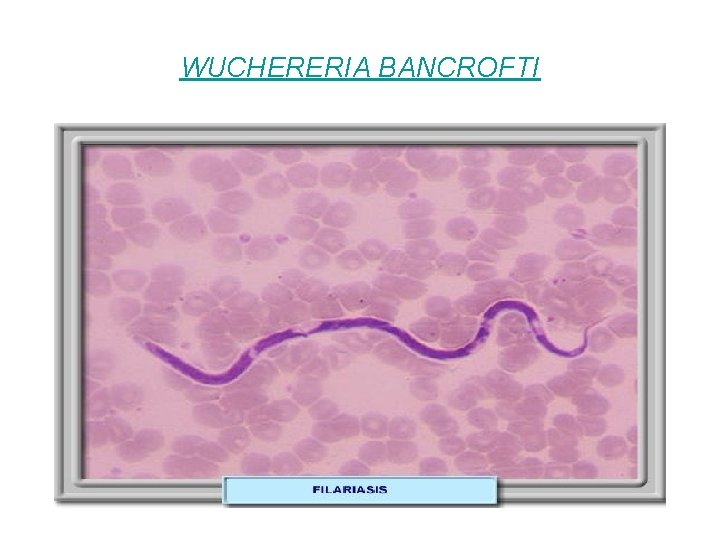 WUCHERERIA BANCROFTI 