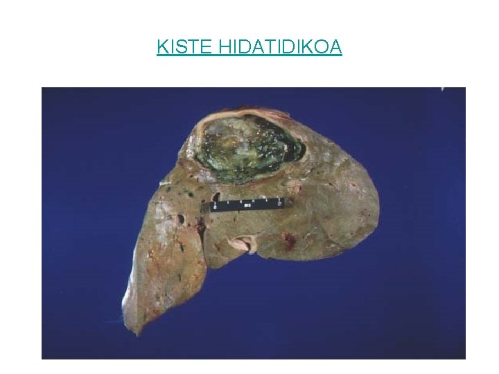 KISTE HIDATIDIKOA 